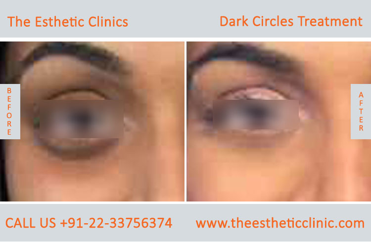 Under Eye Dark Circle Removal Laser Treatment before after photos in mumbai india (2)